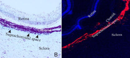 suprachoroidal space